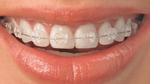 Clear Braces in Blue Springs