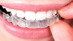 Invisalign Lakewood Orthodontics Lee's Summit Pleasant Hill MO