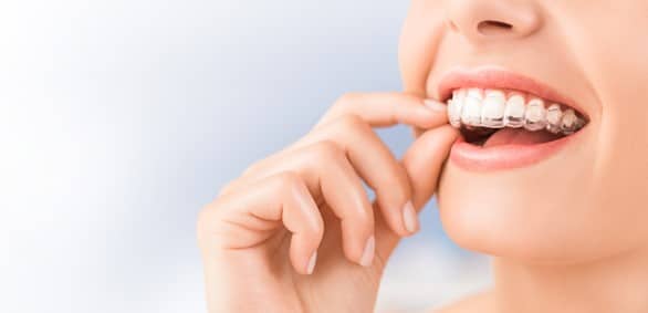 Invisalign Orthodontist in Blue Springs