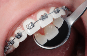 orthodontist in Blue Springs