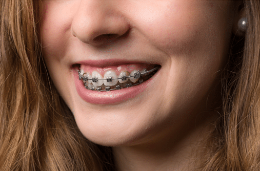 Invisalign Orthodontist in Greenwood